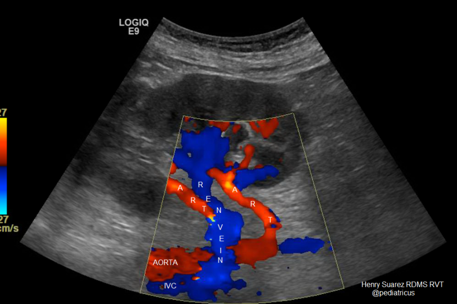 Upper Extremity Veins