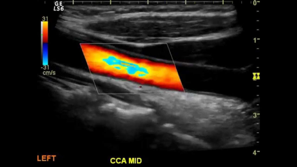 Upper Extremity Veins